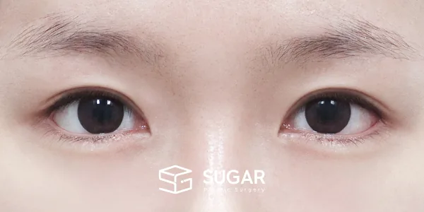 슈가성형외과 첫) 절개 + 뒤밑트임 전후사진 - 수술 후