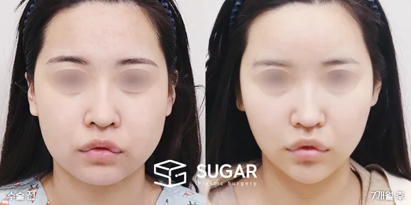 슈가성형외과 첫) 얼굴지방이식+이중턱지방흡입+심부볼제거+턱보톡스 전후사진 - 전후 비교 사진