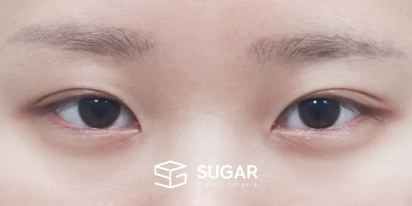 슈가성형외과 첫) 절개 + 앞트임 + 윗트임 + 뒤밑트임 전후사진 - 수술 전