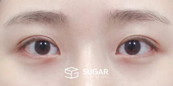 슈가성형외과 첫) 자연유착 + 눈매교정 전후사진 - 수술 후