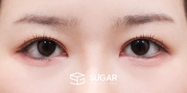 슈가성형외과 첫) 절개 + 앞트임 + 뒤밑트임 전후사진 - 수술 후