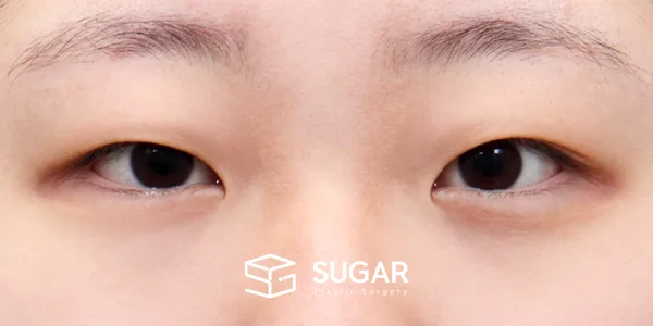 슈가성형외과 첫) 절개 + 눈매교정 + 앞트임 + 윗트임 + 눈 위 지방 제거 전후사진 - 수술 전