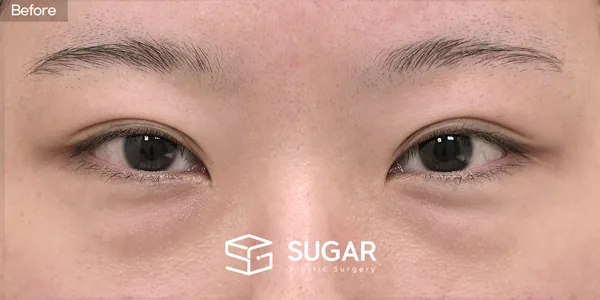 슈가성형외과 첫) 뒤트임 + 밑트임 + 눈밑지방재배치 전후사진 - 수술 전