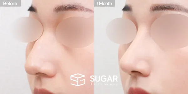 슈가성형외과 첫) 콧대 + 코끝 + 매부리코 + 휜코 + 절골 전후사진 - 45도 수술 전후 비교