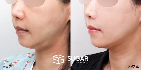 슈가성형외과 첫) 중안면부거상 + 이중턱 지방흡입 + 얼굴 지방이식 전후사진 - 전후 비교 사진