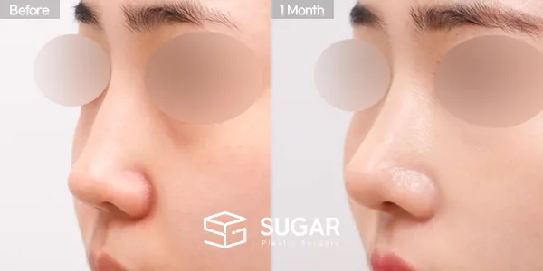 슈가성형외과 첫) 콧대 + 코끝 + 매부리코 + 절골 + 비주 내리기 + 귀연골 전후사진 - 45도 수술 전후 비교