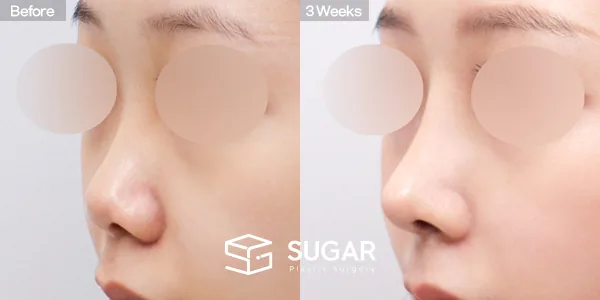 슈가성형외과 첫) 콧대 + 코끝 + 비중격 + 귀연골 전후사진 - 45도 수술 전후 비교