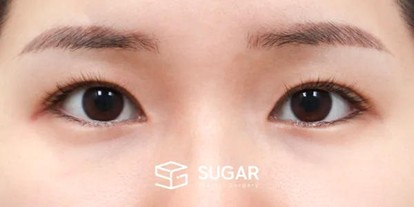 슈가성형외과 첫) 자연유착 + 뒤밑트임 전후사진 - 수술 전