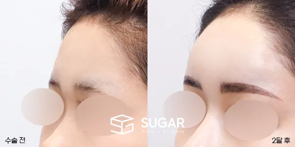 슈가성형외과 첫) 이마필러 전후사진 - 전후 비교 사진