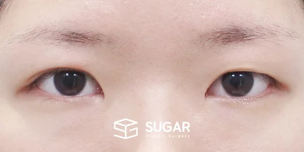 슈가성형외과 재) 재수술 + 자연유착 + 눈매교정 + 앞트임 + 윗트임 + 눈 두덩이 지방 제거 전후사진 - 수술 전