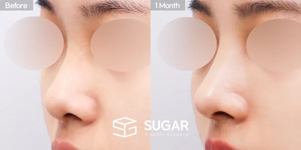 슈가성형외과 첫) 콧대 + 코끝 + 귀연골 전후사진 - 45도 수술 전후 비교