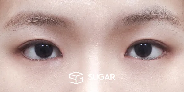 슈가성형외과 첫) 절개 + 앞트임 + 뒤밑트임 전후사진 - 수술 후