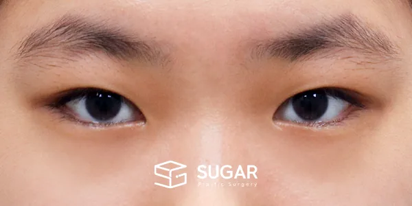 슈가성형외과 첫) 자연유착 + 눈매교정 + 윗트임 + 눈 위 지방 제거 전후사진 - 수술 전