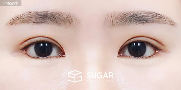 슈가성형외과 재) 재수술 + 절개 + 눈매교정 + 밑트임 전후사진 - 수술 후