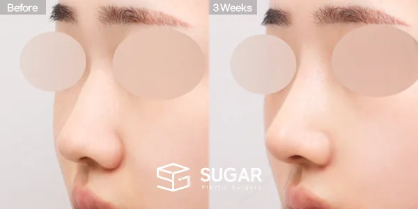 슈가성형외과 첫) 콧대 + 코끝 + 매부리코 + 복코 + 절골 + 귀연골 전후사진 - 45도 수술 전후 비교
