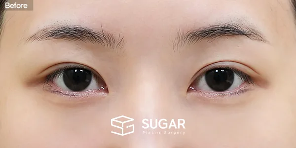 슈가성형외과 첫) 비절개눈매교정 + 윗트임 + 웨이브뒤밑트임 전후사진 - 수술 전