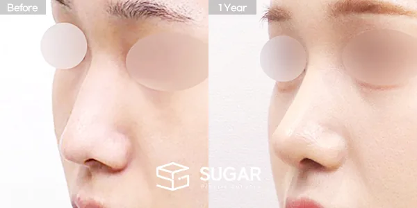 슈가성형외과 첫) 콧대 + 코끝 + 긴코 + 절골 + 귀연골 + 비중격연골 + 매부리 전후사진 - 45도 수술 전후 비교