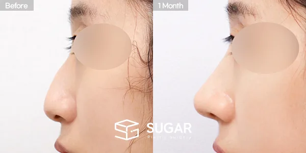 슈가성형외과 첫) 코끝 + 매부리코 + 휜코 전후사진 - 측면 수술 전후 비교