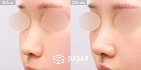 슈가성형외과 첫) 콧대 + 코끝 + 매부리코 전후사진 - 45도 수술 전후 비교