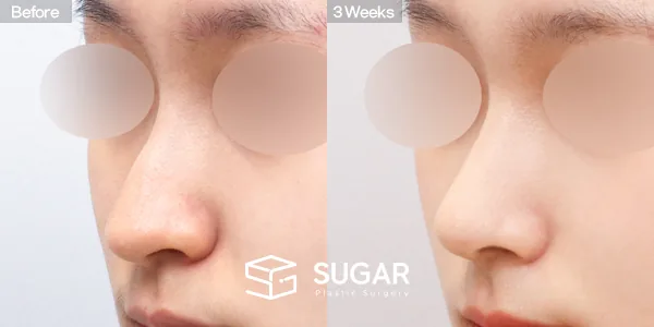 슈가성형외과 첫) 코끝 + 매부리코 + 복코 + 휜코 + 귀연골 전후사진 - 45도 수술 전후 비교