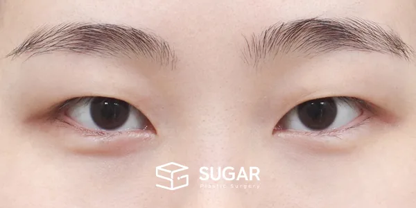 슈가성형외과 첫) 자연유착 + 눈 위 지방제거 전후사진 - 수술 전