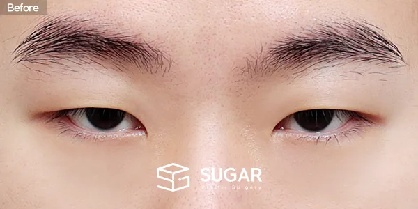 슈가성형외과 첫) 자연유착 + 눈매교정 + 앞트임 + 뒤밑트임 전후사진 - 수술 전