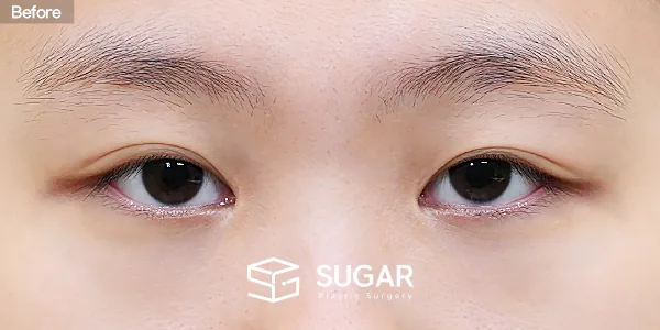 슈가성형외과 재) 재수술 + 절개 + 눈매교정 + 뒤밑트임 전후사진 - 수술 전
