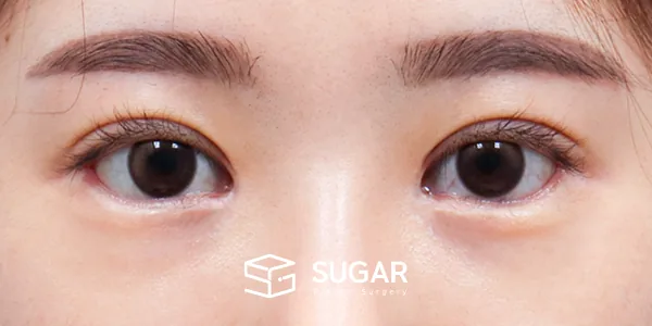 슈가성형외과 재) 재수술 + 절개(두 줄 따기) + 눈 밑 지방재배치 + 뒤밑트임 + 앞트임 복원 흉터 주사 전후사진 - 수술 후