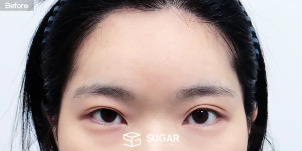 슈가성형외과 재) 절개 재수술+ 눈매교정 + 뒤밑트임 재수술 + 이마거상 전후사진 - 수술 전