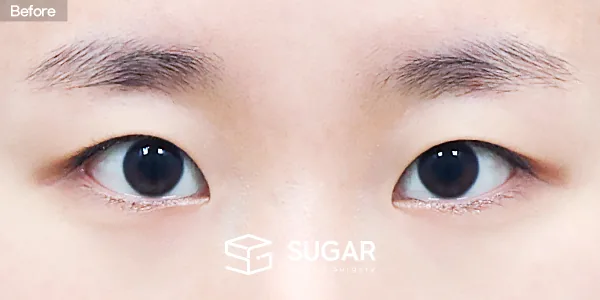 슈가성형외과 첫) 자연유착 + 눈매교정 + 앞트임 전후사진 - 수술 전
