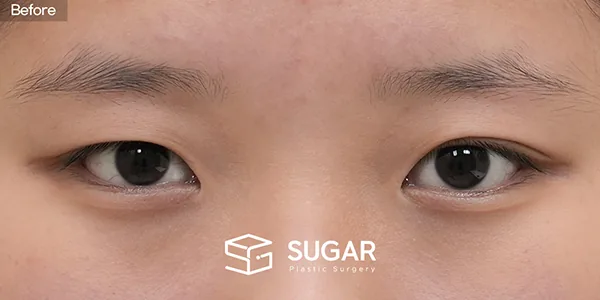 슈가성형외과 첫) 비절개눈매교정 + 앞트임 전후사진 - 수술 전
