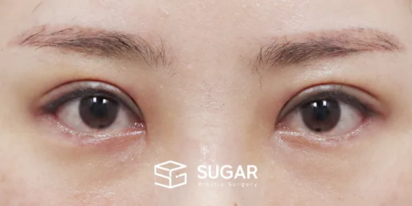 슈가성형외과 첫) 자연유착 + 눈매교정 + 윗트임 + 뒤밑트임 전후사진 - 수술 후