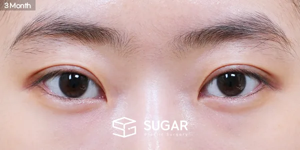 슈가성형외과 첫) 자연유착 + 눈매교정 전후사진 - 수술 후
