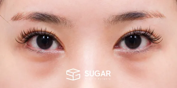 슈가성형외과 첫) 밑트임[R] + 눈 밑 지방재배치 전후사진 - 수술 전