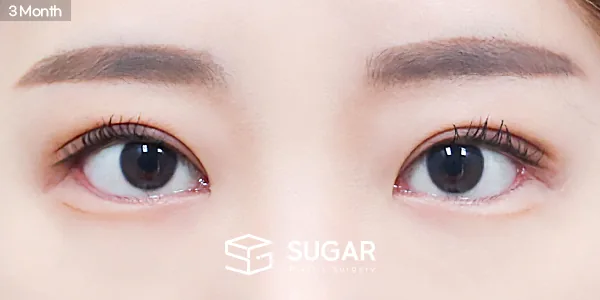 슈가성형외과 재) 재수술 + 절개 + 눈매교정 + 뒤밑트임 전후사진 - 수술 후