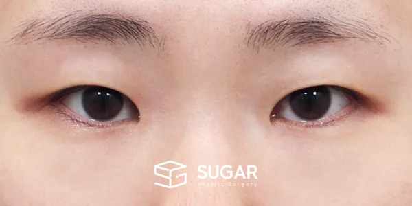 슈가성형외과 첫) 자연유착 + 눈매교정 + 앞트임 + 윗트임 전후사진 - 수술 전