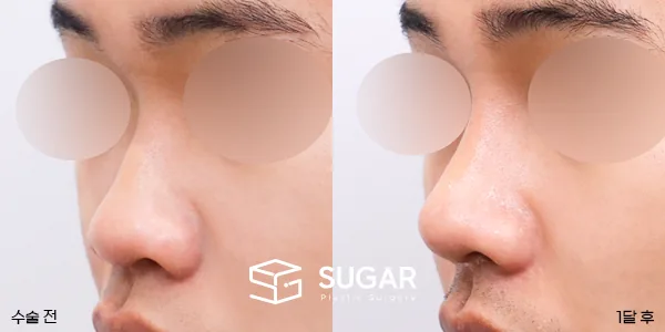슈가성형외과 첫) 콧대 + 코끝 + 복코 + 비순각 교정 + 자가늑 전후사진 - 45도 수술 전후 비교