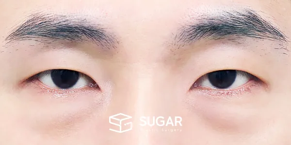 슈가성형외과 첫) 눈밑지방재배치 전후사진 - 수술 전