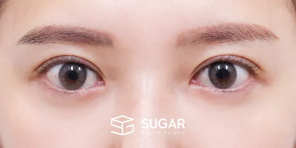 슈가성형외과 첫) 자연유착 + 눈매교정 전후사진 - 수술 후