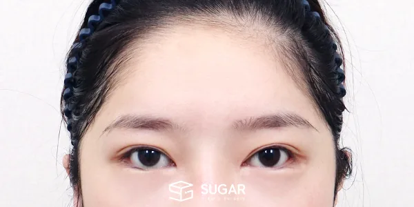 슈가성형외과 재) 뒤밑트임 재수술 + 이마거상 전후사진 - 수술 전