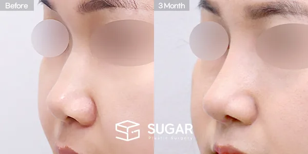 슈가성형외과 첫) 콧대 + 코끝 + 비중격연골 + 귀연골 + 복코 전후사진 - 45도 수술 전후 비교