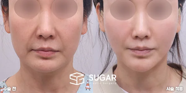 슈가성형외과 첫) 실리프팅 전후사진 - 전후 비교 사진