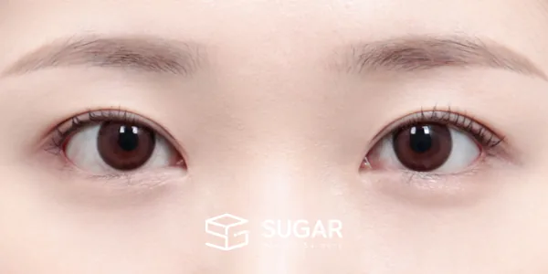 슈가성형외과 재) 자연유착 + 눈매교정 + 윗트임 + 뒤밑트임 + 재수술 전후사진 - 수술 후