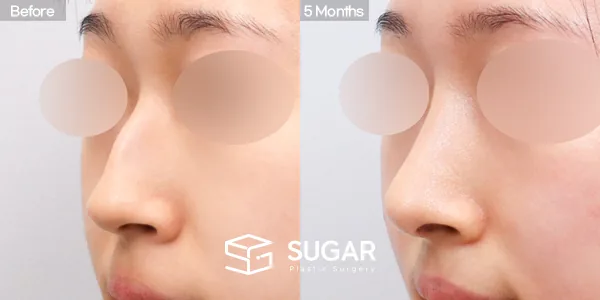 슈가성형외과 첫) 콧대 + 코끝 + 매부리코 + 휜코 전후사진 - 45도 수술 전후 비교