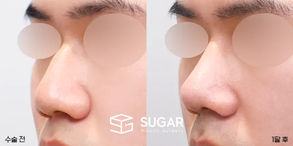 슈가성형외과 첫) 무보형물 + 매부리 + 복코 + 비주 지지 + 근막 + 비중격 + 귀연골 전후사진 - 45도 수술 전후 비교