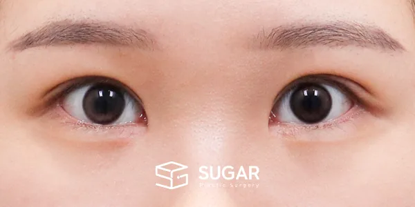 슈가성형외과 첫) 절개 + 눈매교정 + 앞트임 + 윗트임 + 눈 위 지방 제거 전후사진 - 수술 후