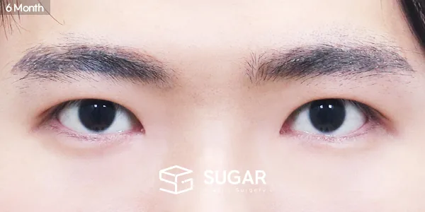 슈가성형외과 첫) 절개 + 눈매교정 + 앞트임 전후사진 - 수술 후