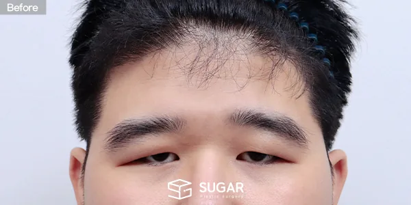 슈가성형외과 첫) 이마거상 + 절개 + 눈매교정 + 눈 두덩이 지방 제거 전후사진 - 수술 전