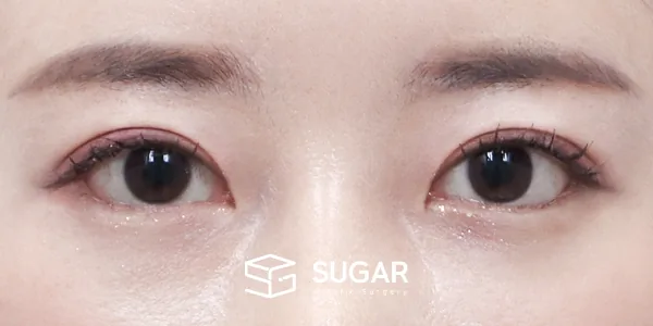 슈가성형외과 재) 재수술 + 자연유착 + 윗트임[L] + 뒤밑트임 전후사진 - 수술 후