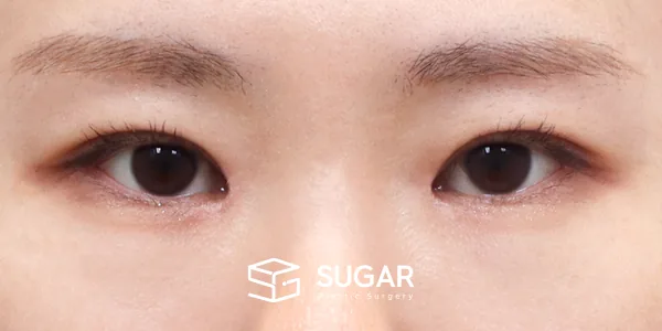 슈가성형외과 첫) 자연유착 + 눈매교정 + 앞트임 + 윗트임 전후사진 - 수술 후